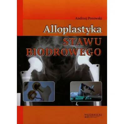 Alloplastyka stawu biodrowego - Andrzej Pozowski