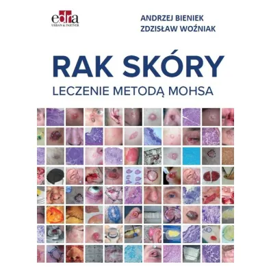Rak sk�ry. Leczenie metod� Mohsa - Andrzej Bieniek, Zdzis�aw  Wo�niak