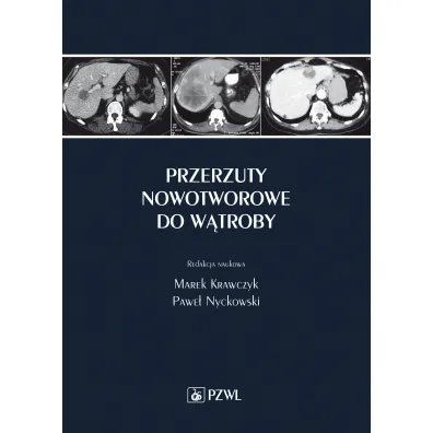 Przerzuty nowotworowe do w�troby - Marek Krawczyk, Pawe� Nyckowski